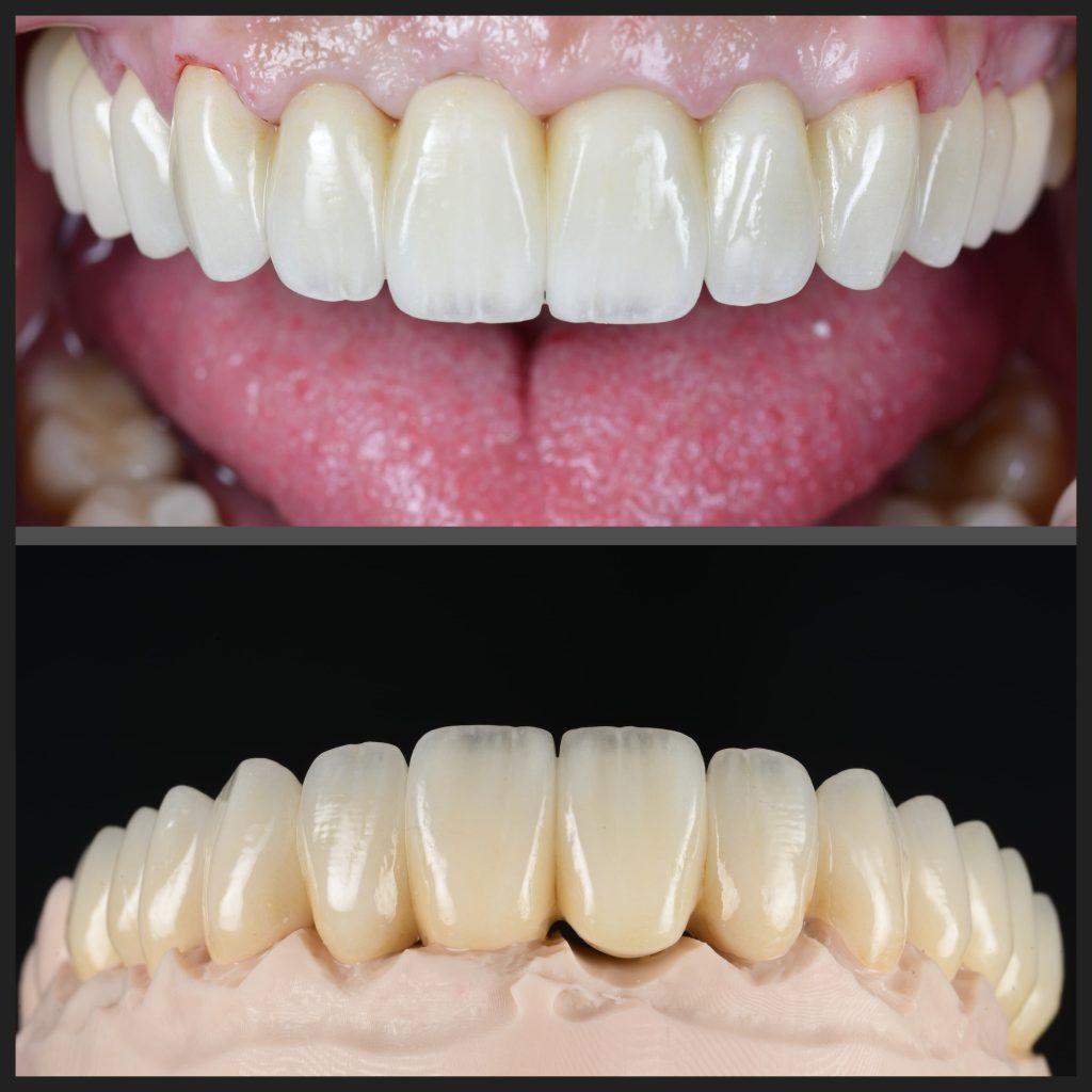 Înlocuiri lucrări protetice