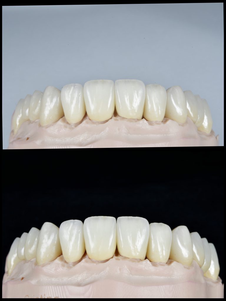 Fațete și coroane integral ceramice